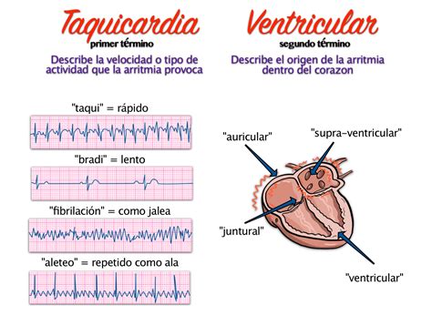 arritmia ventricular complexa
